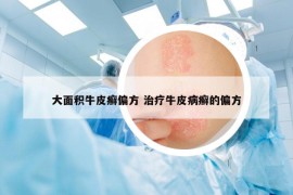 大面積牛皮癬偏方 治療牛皮病癬的偏方