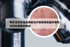 黃芪當(dāng)歸生地白蒺藜治療銀屑病有副作用嗎 當(dāng)歸白蒺藜白鮮皮