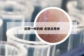 丘陵一樣的癬 皮膚丘陵狀