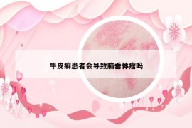 牛皮癬患者會(huì)導(dǎo)致腦垂體瘤嗎