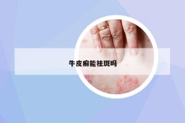 牛皮癬能祛斑嗎