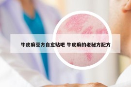 牛皮癬豆方自愈貼吧 牛皮癬的老秘方配方