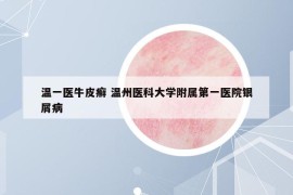 溫一醫(yī)牛皮癬 溫州醫(yī)科大學(xué)附屬第一醫(yī)院銀屑病