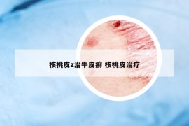 核桃皮z治牛皮癬 核桃皮治療