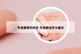 牛皮癬現(xiàn)代妙方 牛皮癬治療小偏方