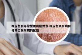 紅皮型和尋常型銀屑病并發(fā) 紅皮型銀屑病和尋常型銀屑病的區(qū)別