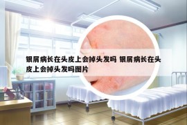 銀屑病長在頭皮上會掉頭發(fā)嗎 銀屑病長在頭皮上會掉頭發(fā)嗎圖片