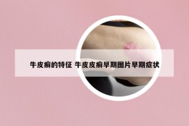 牛皮癬的特征 牛皮皮癬早期圖片早期癥狀