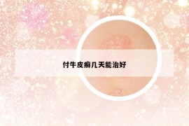 付牛皮癬幾天能治好