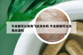 牛皮癬可以用海飛絲洗頭嗎 牛皮膚癬可以洗海水澡嗎