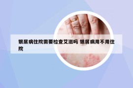 銀屑病住院需要檢查艾滋嗎 銀屑病用不用住院