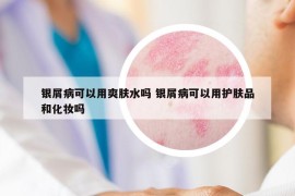 銀屑病可以用爽膚水嗎 銀屑病可以用護(hù)膚品和化妝嗎