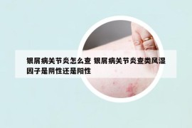 銀屑病關(guān)節(jié)炎怎么查 銀屑病關(guān)節(jié)炎查類(lèi)風(fēng)濕因子是陰性還是陽(yáng)性
