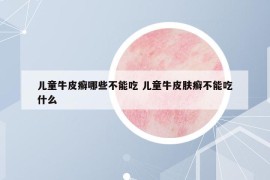 兒童牛皮癬哪些不能吃 兒童牛皮膚癬不能吃什么