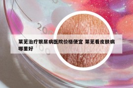 萊蕪治療銀屑病醫(yī)院價格便宜 萊蕪看皮膚病哪里好
