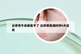 丘疹性牛皮癬變平了 丘疹銀屑病好轉(zhuǎn)6大征兆
