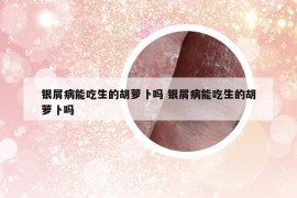 銀屑病能吃生的胡蘿卜嗎 銀屑病能吃生的胡蘿卜嗎