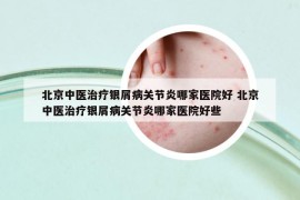 北京中醫(yī)治療銀屑病關(guān)節(jié)炎哪家醫(yī)院好 北京中醫(yī)治療銀屑病關(guān)節(jié)炎哪家醫(yī)院好些