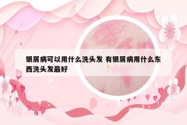 銀屑病可以用什么洗頭發(fā) 有銀屑病用什么東西洗頭發(fā)最好