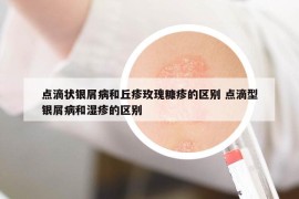 點滴狀銀屑病和丘疹玫瑰糠疹的區(qū)別 點滴型銀屑病和濕疹的區(qū)別