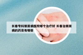 長春?？沏y屑病醫(yī)院哪個治療好 長春治銀屑病的藥膏有哪些
