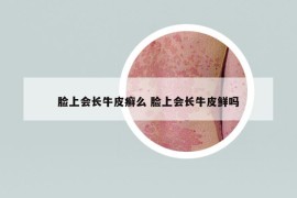 臉上會(huì)長(zhǎng)牛皮癬么 臉上會(huì)長(zhǎng)牛皮鮮嗎