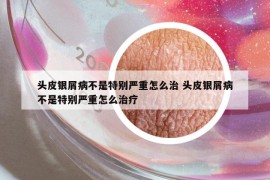 頭皮銀屑病不是特別嚴重怎么治 頭皮銀屑病不是特別嚴重怎么治療