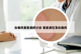 白癜風(fēng)銀屑病研討會(huì) 銀屑病引發(fā)白癜風(fēng)