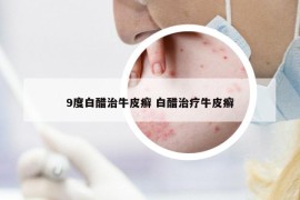 9度白醋治牛皮癬 白醋治療牛皮癬