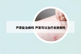 蘆薈能治癬嗎 蘆薈可以治療皮膚癬嗎