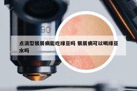 點(diǎn)滴型銀屑病能吃綠豆嗎 銀屑病可以喝綠豆水嗎