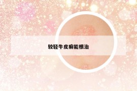 較輕牛皮癬能根治