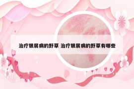 治療銀屑病的野草 治療銀屑病的野草有哪些