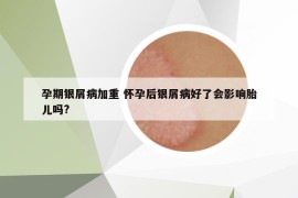 孕期銀屑病加重 懷孕后銀屑病好了會影響胎兒嗎?