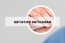 后腦勺有牛皮癬 后腦勺頭皮銀屑病