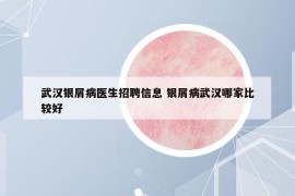 武漢銀屑病醫(yī)生招聘信息 銀屑病武漢哪家比較好