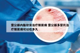 雷公藤內(nèi)酯軟膏治療銀屑病 雷公藤多苷片治療銀屑病可以吃多久