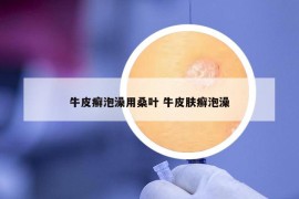 牛皮癬泡澡用桑葉 牛皮膚癬泡澡