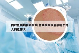 同時魚鱗病和銀屑病 魚鱗病跟銀屑病哪個對人的危害大