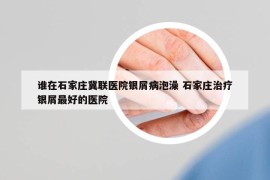 誰在石家莊冀聯(lián)醫(yī)院銀屑病泡澡 石家莊治療銀屑最好的醫(yī)院