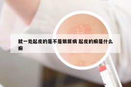 就一處起皮的是不是銀屑病 起皮的癬是什么癬