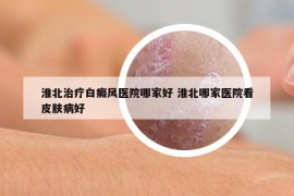淮北治療白癜風(fēng)醫(yī)院哪家好 淮北哪家醫(yī)院看皮膚病好