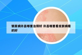 銀屑病許昌哪里治得好 許昌哪里看皮膚病看的好