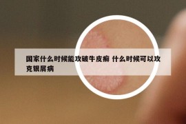 國家什么時候能攻破牛皮癬 什么時候可以攻克銀屑病
