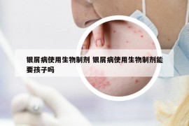銀屑病使用生物制劑 銀屑病使用生物制劑能要孩子嗎