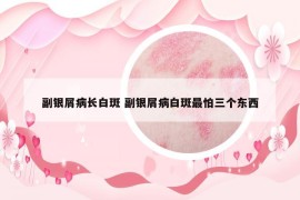副銀屑病長白斑 副銀屑病白斑最怕三個東西