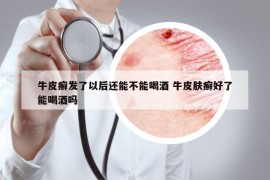 牛皮癬發(fā)了以后還能不能喝酒 牛皮膚癬好了能喝酒嗎