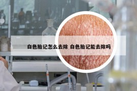 白色胎記怎么去除 白色胎記能去除嗎