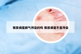 銀屑病是腳氣傳染的嗎 銀屑病是不是傳染
