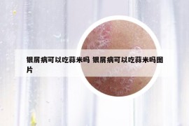銀屑病可以吃蒜米嗎 銀屑病可以吃蒜米嗎圖片